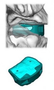 EIT impianto fusione spinale in titanio stampato in 3d 02